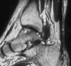 6 Acta Orthop Traumatol Turc Suppl fiekil 6. T1-a rl kl parakoronal kesitte sa ayak bile inde talusun medial omzunda osteokondritis dissekans görünümü. Ayn olgunun MRA görünümü.