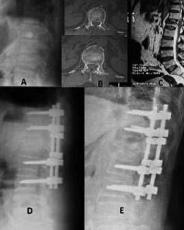 hastamızda posterior yaklaşımla pediküler vida fiksasyonu ile stabilizasyon, indirekt dekompresyon ve füzyon uygulandı. Hastaların tamamı postoperatif erken dönemde mobilize edildi.