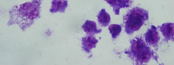 olmuş J774 makrofaj hücreleri (Giemsa boyama, 24 saat sonra, 100x) 1 mg/ml