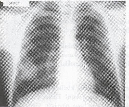 RADYOLOJİ PA akciğer grafisinde Rüptüre olmamış