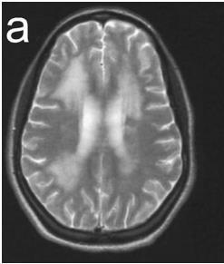 MRG: Yaygın periventriküler beyaz cevherde sinyal değişikliği PMP 500 mg/ga 3 kez,