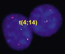 Multiple Myeloma Monoklonal immunglobin (M proteini) salgılayan plazma hücrelerinin malign proliferasyonudur.
