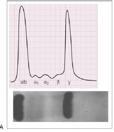 Normal Serum protein elektroforezi ve M proteini (monoclonal spike) Serum Elektroforezi: