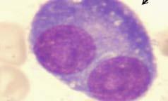 Myeloma