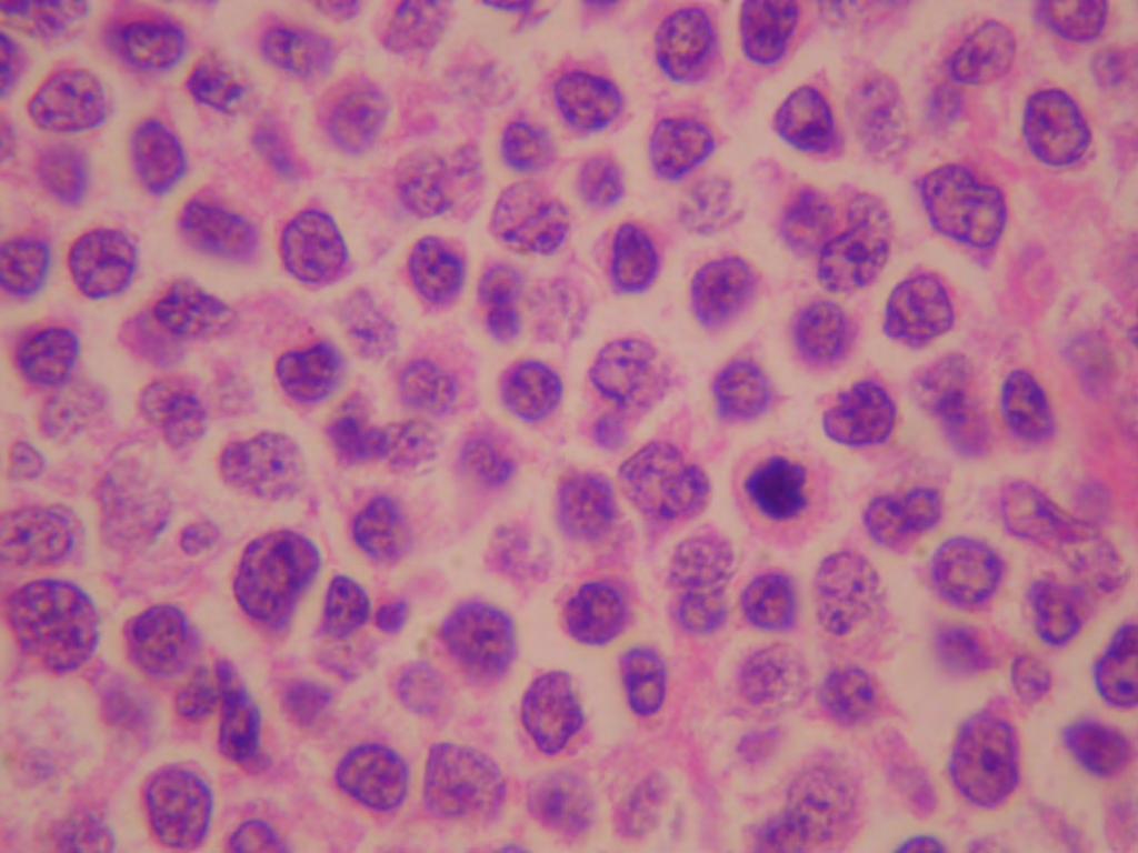 Mantle Hücreli Lenfoma Morfolojik