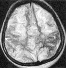 Kranyal MRG incelemede bilateral oksipital loblarda korteksi ve subkortikal beyaz cevheri tutan, bazal gang- 476 Aral k 2001 liyon düzeylerinde, mezensefalonda, periventriküler derin beyaz cevherde