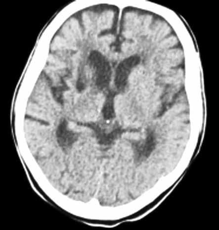 44 Parkinson Hast Hareket Boz Der Critchley 1929 da piramidal tipte olmayan rijidite ve hareket yavaşlamasının ön planda olduğu, fakat genelde tremorun olmadığı vasküler parkinsonizm (VP) kavramını