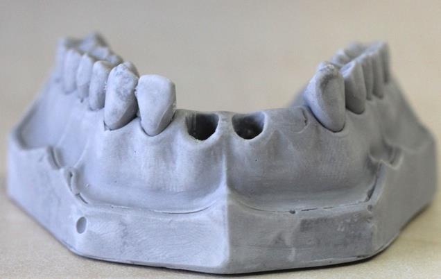 Sağ ve sol santral keser dişler ve lateral keser diş modelden uzaklaştırıldı.