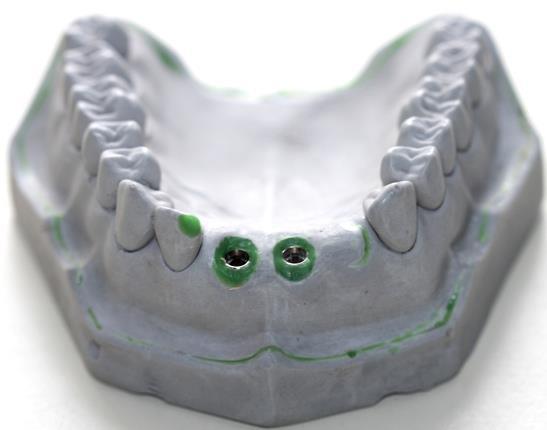 53 Modelde komşu dişlerin açılanmaları dikkate alınarak santral keser dişlerin göstermesi gereken açılanmayla, iki santral keser diş bölgesine implant analogları