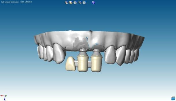 Vida açıklıkları dental mum ile kapatılarak düz bir yüzey haline getirildi.