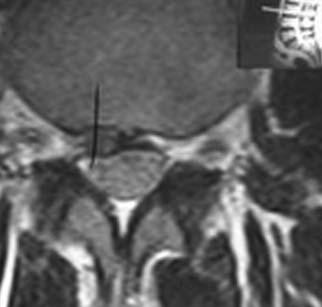 Yine ameliyat ile ilgili postoperatif olabilecek spinal stenoz, araknoidit gibi komplikasyonlar da ifleme flikayetlerinin devam etmesine ve hatta daha kötüleflmesine neden olabilmektedir (2).