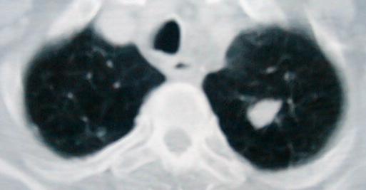 Hasdıraz L, Kahraman A Resim 1. Sol üst lobda soliter pulmoner nodül tesbit edilen hastanın CT görüntüsü Tablo II.