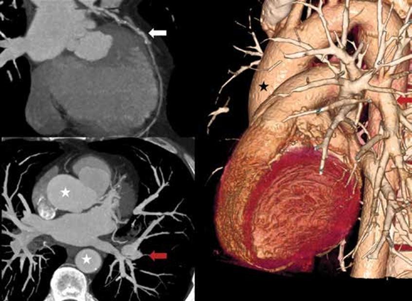 Triple rule out CT BT anjiyografi ile koroner arterler, pulmoner arterler ve aorta hızlı ve etkin şekilde görüntülenebilmektedir.
