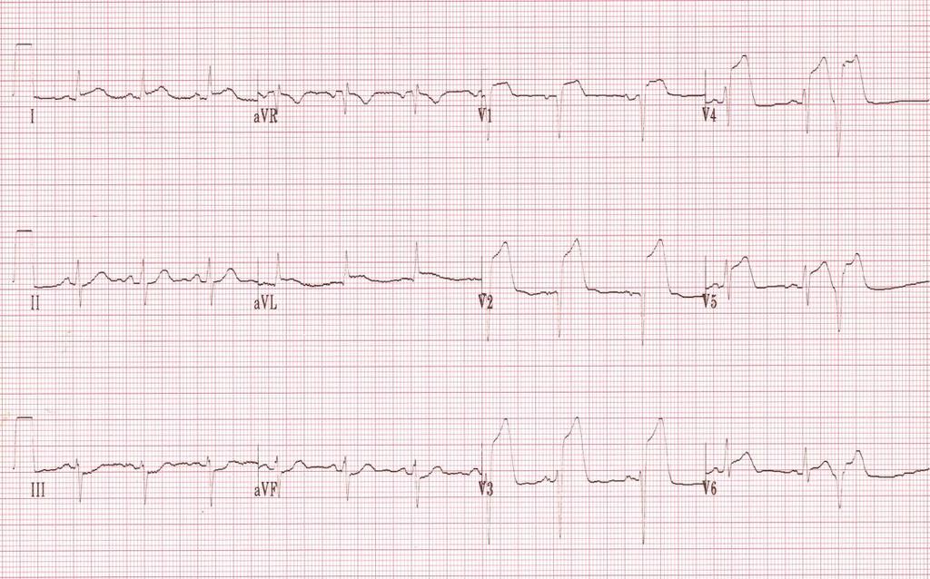 STEMI: Komşu derivasyonlarda ST segment elevasyonu ve Q dalgası