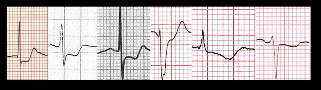 NSTE-AKS NSTEACS ile birlikte görülen iki temel EKG anormalliği mevcuttur: ST segment depresyonu T dalga düzleşmesi veya inversiyonu Dinamik ST segment ve T dalga