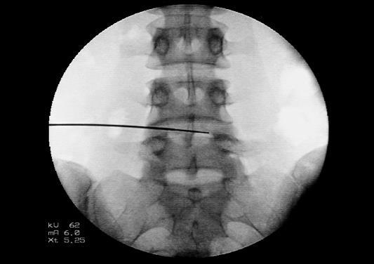 optik kablosunun sokulması ile gerçekleştirilir Takiben lazer enerjisini kullanarak dejenere dokulardaki istenmeyen disk yapılarının vaporizasyonu sağlanır Diskteki enflamasyon düşürülür ve disk