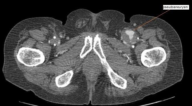 Figure 1: pseudoaneurysm of left femoral