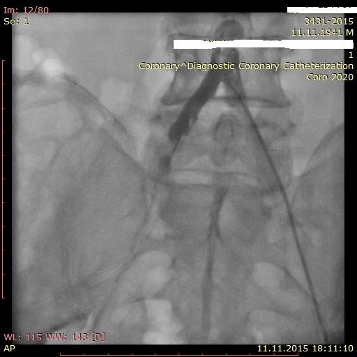 Figure 2: The occlusion of iliac