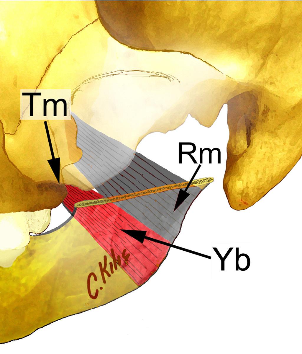 Şekil 15. Tuber maxilla (Tm), musculus pterygoideus medialis in yüzeyel başı (Yb), ve ramus mandibulae (Rm).