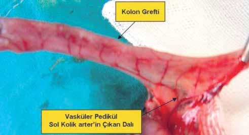 Bu çalışmada, ratlarda sol kolik arterin çıkan dalı ile beslenen sol kolon grefti hazırlandıktan sonra bu greftin proksimal ve distal uçlarında meydana gelen mukozal iskemik değişiklikler ve bu