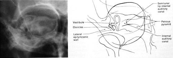 Stenver pozisyonu Stenver pozisyonu Transorbital projeksiyon Alın