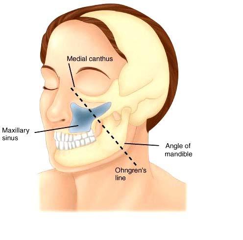 Nazal kavite: Septum, Taban, Vestibul, Lateral duvar Paranazal sinüsler: Maksiller, Ethmoid, Frontal, Sfenoid Çizgi üstü (superoposterior maksilla) yapılardan