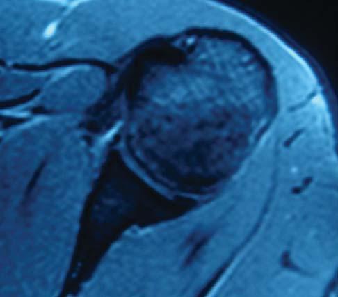 Taflkoparan ve ark. Akut anterior omuz ç k nda d fl rotasyonda tespit 279 sonras d fl rotasyonda tespit yap lmas gerekti ini gerek klinik, gerek kadavra çal flmalar ortaya ç karm flt r.