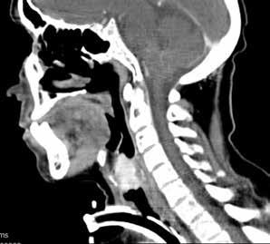 [S-06] Laringeal Myofibroblastik Tümör: Nadir Olgu Melis Demirağ Evman, Sedat Aydın, Hakan Avcı Sağlık Bilimleri Üniversitesi Dr.