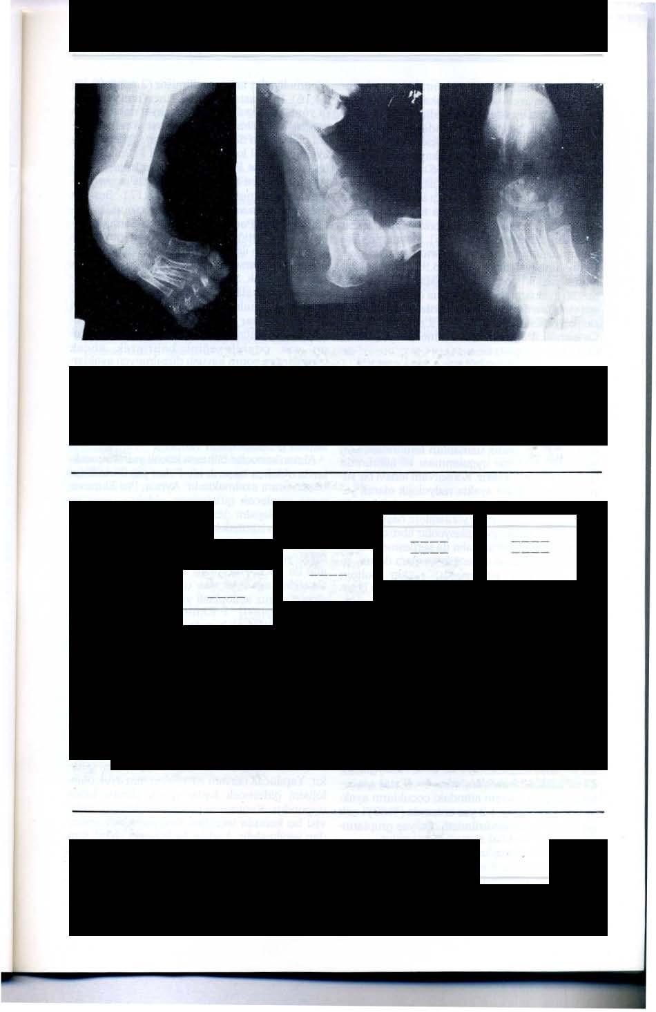 137- A.Biçimoğlu Resim: 2- N.Ç. isimli hastanın A- preob sağ ayak grafisi, 8- postop 19 ay sonraki sağ ayak yan grafisi. C- pestop sağ ayak ön-arka grafisi.
