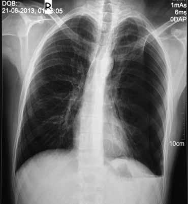 BÖLÜM 17 Pnömotoraks ve Cerrahi Tedavisi 169 Şekil 1: Akciğer grafisinde solda pnömotoraks alanının belirlenmesinde altın standarttır.