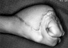 Ekstensör tendonu yaralanan her parma n toplam aktif hareket miktarlar Tablo 4 de, kavrama gücü, ifle dönme süreleri ve fonksiyonel sonuçlar Tablo 1
