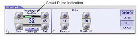 Constellation* Vision System Smart Pulse Ultrasonik pulse süresi 20 ms den aşağıya düşerse özel bir algoritma devreye girer.