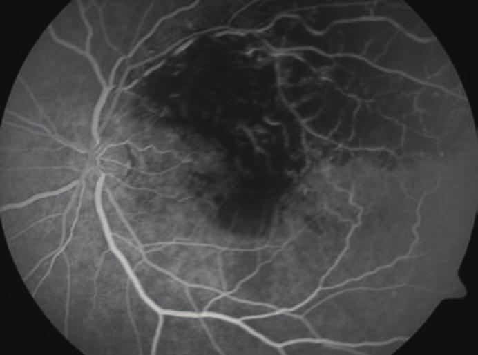 yapılamadı.ortalama fovea kalınlığı enjeksiyon öncesi 495±125 µm, 1. ayda 279±75 µm, 3. ayda 297±83 µm ve 6. ayda 345±91 µm olarak saptandı (Tablo 3, Grafik). Enjeksiyon sonrası 1. ve 3.