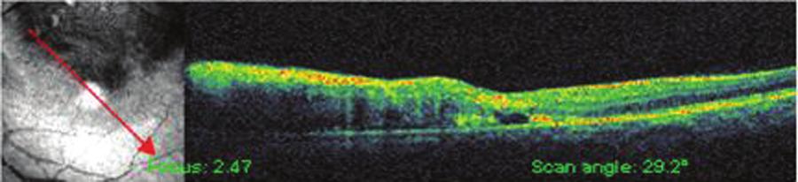 30 Retinal Ven Tıkanıklığına Bağlı Maküla Ödemi Tedavisinde İntravitreal Bevacizumab... Resim 7: Ven dal tıkanıklığı olan olgunun enjeksiyon öncesi OKT si.