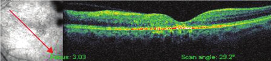 Farklı çalışmalarda bu tedavi yöntemi ile görme keskinliğinde ve retina dolaşımında artış, maküla ödeminde ise düzelme elde edilmiştir.