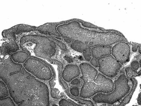 10 KBB Uygulamaları Şekil 1. Stromaya doğru invajinasyonlarla büyüyen değişik boyutlarda epitelyal hücre adaları (H-E x 100). Şekil 2. Stromada hafif lenfositik infiltrasyon izlenmektedir (H-E x 200).
