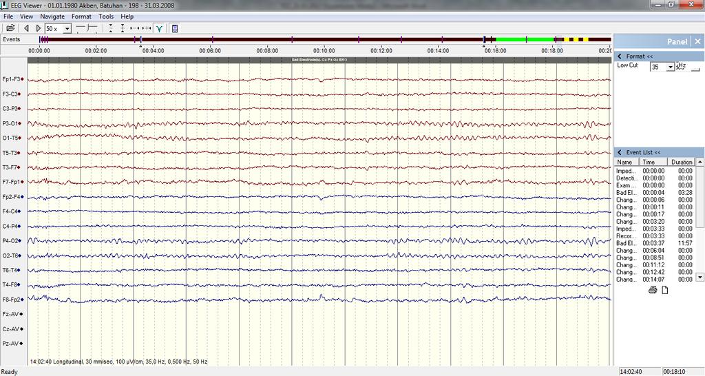 EEG ver kayıt şlemler 20 dakka sürmüştür. Bu 20 dakkanın 1 dakkası dern nefes alı verme (Herventlasyon) 1 dakkası se flaş ışığı uyartısı şeklnde geçmştr.