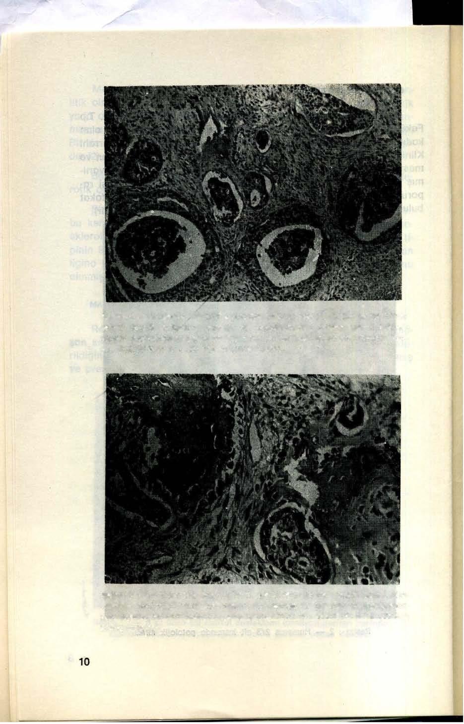Resim: 3- Ortasında eoslnofilik granüllü nekroz.