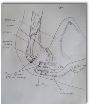 Cerrahi teknik Ameliyatlar şezlong pozisyonunda, genel anestezi altında ve 3 artroskopik portal (ön, yan ve arka) kullanılarak yapılmıştır.