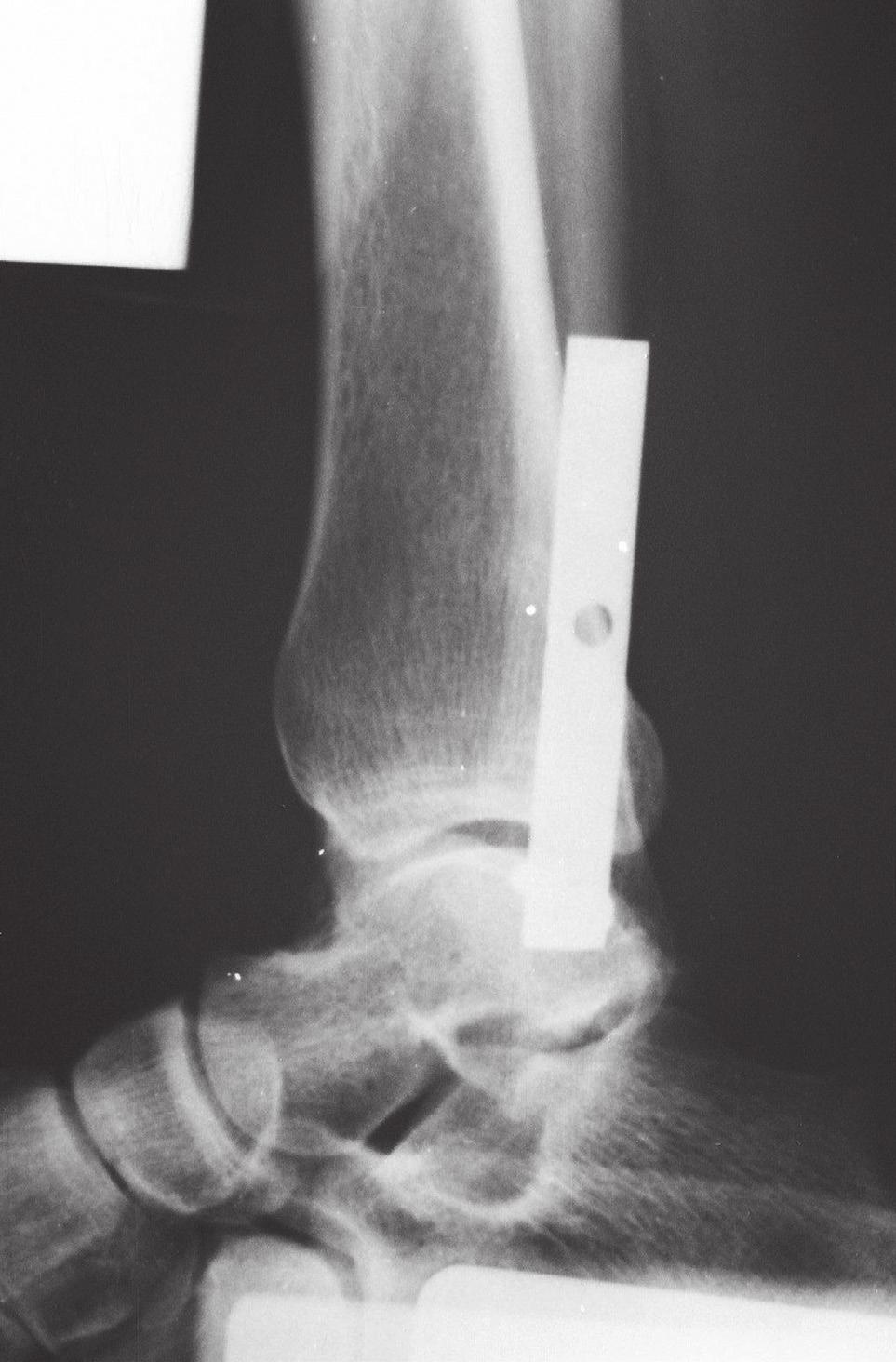 A supplemental syndesmotic screw was inserted and removed later on, of which the empty hole of the tibia and the lower tip of the fibula) on both injured and uninjured ankles.