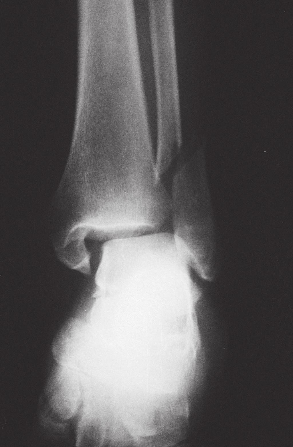 (a) (b) Figure 4. AP (a) and Figure 4. Lateral (b) radiographs of bimalleolar fractures of the ankle (Type C, according to Danis-Weber) osteolysis around the placement of the syndesmotic screw.