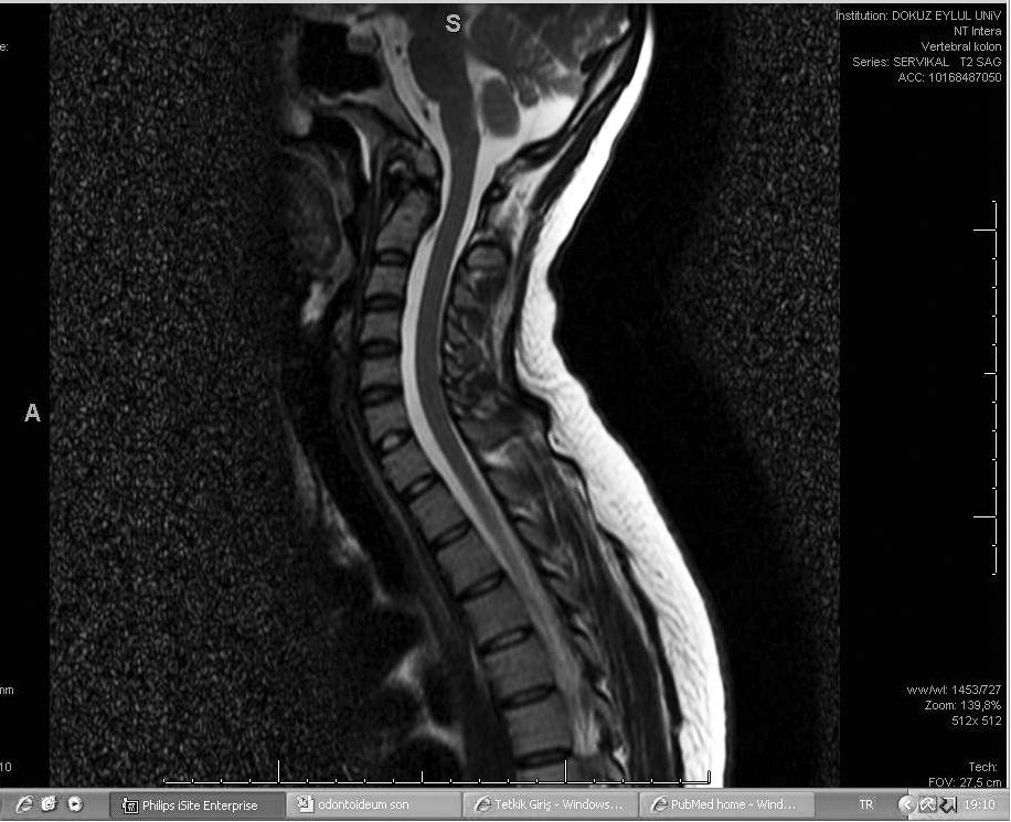 Bu hastalar atlantoaksiyel instabilite ve spinal kord kompresyonu açısından yüksek risk taşımaktadırlar (4). Bu anomali tip 1 ve tip 2 odontoid fraktürleri taklit edebilir (2).