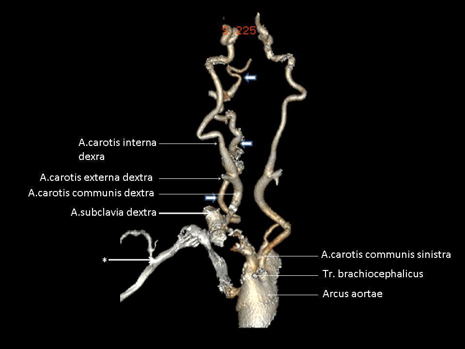 Resim 24. Aynı olgunun kemik ve diğer yumuģak dokuları çıkarılarak elde olunan 3 boyutlu anjiografi görüntüsü. Arteria carotis communis ve interna dextra ile a.