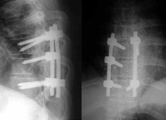524 Acta Orthop Traumatol Turc Düz radyografilerle yapılan inceleme sonucunda kararsız kalınan olgularda vidaların durumu bilgisayarlı tomografi (BT) ile incelendi.