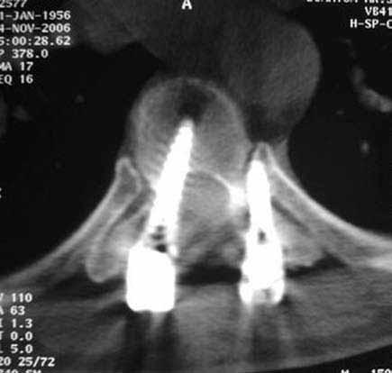 Bilgisayarlı tomografi incelemesine, gözlemcilerin üç ayrı değerlendirmede sonuca varamadığı olgularda, düz radyografide anormal yer değiştirme gösteren vidalar için ve pedikül duvarı yırtılması veya
