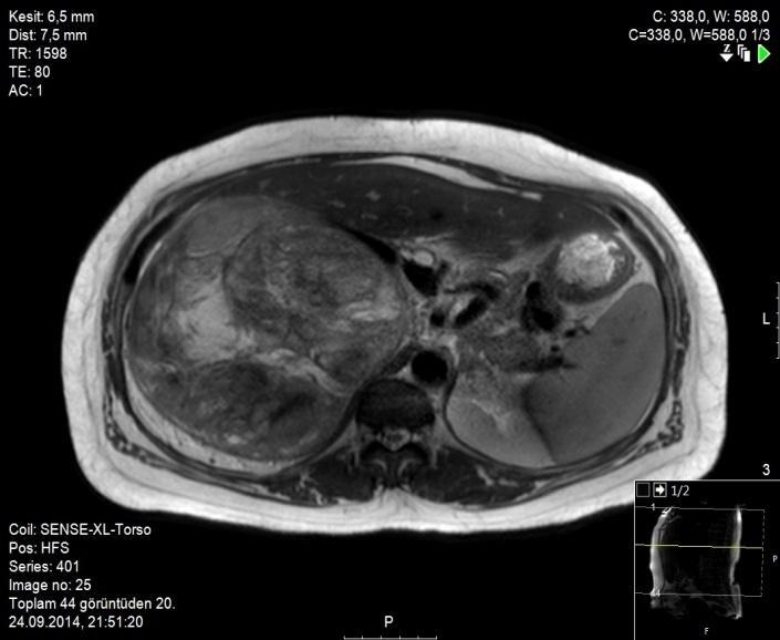 Adrenokortikal onkositik karsinomlar özellikle sağ adrenal gland yerleşimli olanlar ve büyük olanlar- hem karaciğer hem de böbrek ile komşulukları nedeniyle histopatolojik olarak benzer tümörler de