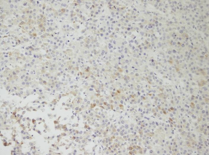 Sitokeratin ile yaygın sitoplazmik reaksiyon görülmektedir. Resim-9. İmmunohistokimyasal inceleme (x200). Inhibin ile yaygın sitoplazmik reaksiyon. Resim-10. İmmunohistokimyasal inceleme (x200). Epitelyal membranöz antijen ile soluk sitoplazmik reaksiyon.