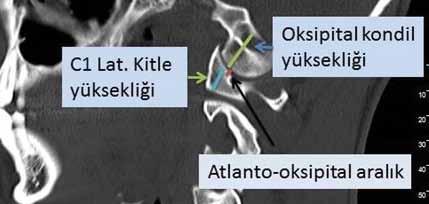 Atlanto-oksipital aralık iki taraflı ölçülür ve ortalaması alınır. Normal sınırları 0 ile 2 mm arasıdır.