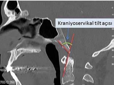 tanımlamışlardır (Şekil 15). Kontrol grubunda sagital eğim açısını 60,2±9,2 baziler invajinasyon ve atlanto-aksiyel dislokasyonda 84,0±15,1 olarak bulmuşlardır (5).