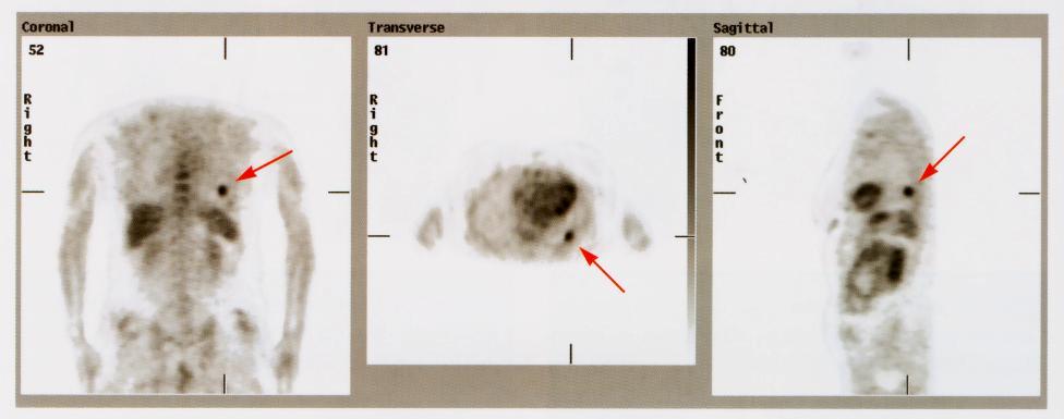 PET, PET/BT Soliter Pulmoner Nodüller 5 yıldır izlemde olan ancak son dönemde BT de büyüdüğü tespit edilen nodül